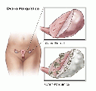 Síndrome de Ovario Poliquístico, una enfermedad que afecta a mujeres jóvenes 