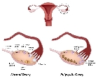 Definición del síndrome ovario poliquístico