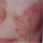 El genoma del acne, fue descodificado.