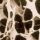 Hombres sobre 50 años: 20% con osteoporosis...