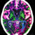 Estudio demostró que el Alzheimer sería una enfermedad infecciosa