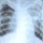 Tuberculosis amenaza Europa