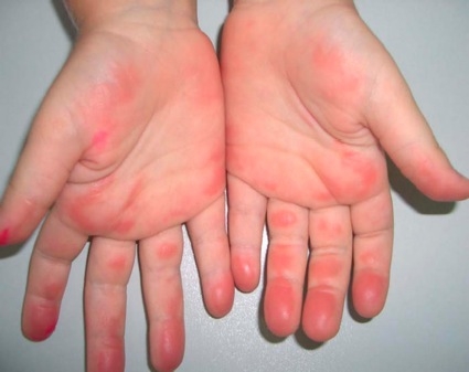 Tejido de algodón, palta y algas, previene enfermedades dermatológicas