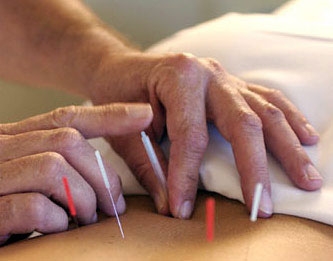 Acupuntura alivia dolores de Síndrome de Ovario Poliquístico