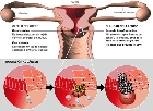 Infecciones no tratadas en la zona genital pueden derivar a cáncer 