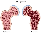 Qué es y cómo se trata la osteoporosis