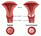 Cáncer de ovario