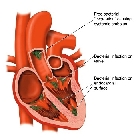 ¿Sabe usted qué es la endocarditis infecciosa?