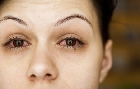 Conjuntivitis. Características y tratamiento de la conjuntivitis.