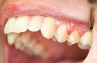 Enfermedades periodontales: mucho cuidado