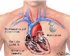 Las enfermedades cardiovasculares son la principal causa de muerte en el mundo