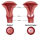 Cáncer de cuello Cérvico