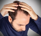 Injerto: Solución definitiva a la Alopecia
