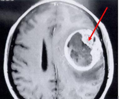 Imagen de resonancia magnética (secuencia T1 con medio de contraste llamado gadolinio) que muestra la imagen típica de un glioma maligno (llamado glioblastoma multiforme) en el hemisferio cerebral izquierdo (el tumor se ve a su derecha en la pantalla, flecha roja).